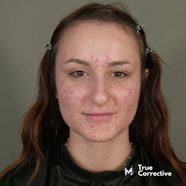 Case Study: Chiara TC19 • Master Class di Make Up Online su Acne Cistica